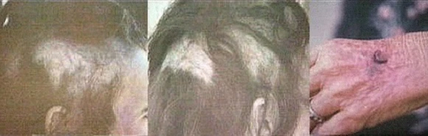 Suốt 18 năm kế tiếp, ông phụ trách chữa trị miễn phí cho Betty, vì bà không có khả năng tài chính chi trả. Tình trạng sức khỏe của Betty cũng ngày càng xấu, cuối cùng chuyển sang mắc ung thư.