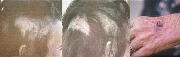 Suốt 18 năm kế tiếp, ông phụ trách chữa trị miễn phí cho Betty, vì bà không có khả năng tài chính chi trả. Tình trạng sức khỏe của Betty cũng ngày càng xấu, cuối cùng chuyển sang mắc ung thư.