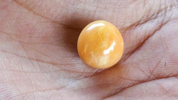 Nhưng cô gái nghèo sau đó ngạc nhiên khi nhận ra đây thực chất là một viên ngọc trai Melo có đường kính 1,5 cm, nặng 6 gram. Viên ngọc ốc này có thể có giá lên tới hàng chục nghìn bảng Anh (tương đương hàng trăm triệu đồng).