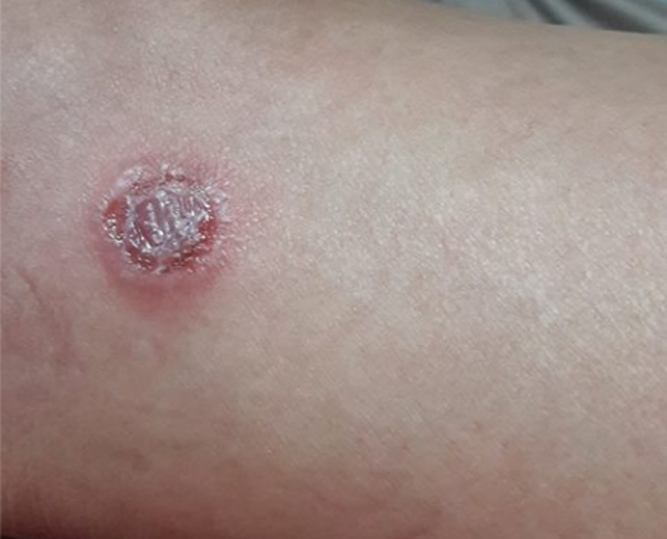 Hoại tử chân. Khi mạch máu không khỏe, vết thương ở bàn chân dễ bị loét, thậm chí hoại tử. Tình trạng bắt nguồn từ việc mạch máu bị thu hẹp, vết thương thiếu máu cục bộ, thiếu oxy. Một khi không được cung cấp đầy đủ dưỡng chất, vết thương dễ mưng mủ, nhiễm trùng hơn.