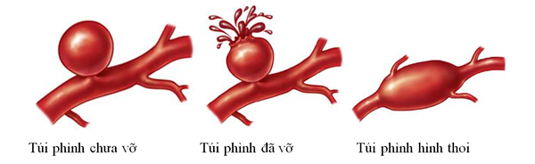 Tiếp nhận ca bệnh, bác sĩ chỉ định chụp CT. Hình ảnh cho thấy, bệnh nhân bị phình động mạch não. Một khi mạch máu não vỡ sẽ xảy ra tình trạng xuất huyết nội sọ, nguy hiểm tính mạng bất cứ khi nào.