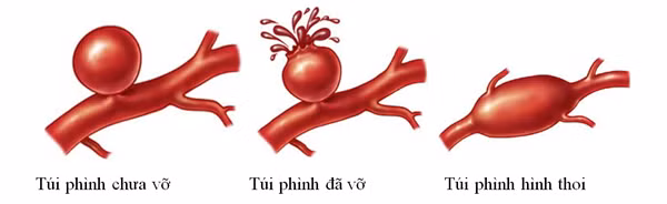 Tiếp nhận ca bệnh, bác sĩ chỉ định chụp CT. Hình ảnh cho thấy, bệnh nhân bị phình động mạch não. Một khi mạch máu não vỡ sẽ xảy ra tình trạng xuất huyết nội sọ, nguy hiểm tính mạng bất cứ khi nào.