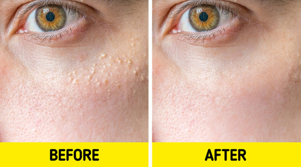 Mụn thịt không phải là bệnh lý về da, không gây đau đớn nên chúng được đánh giá là vô hại với cơ thể. Tuy nhiên, những nốt sần sùi có thể khiến bạn gái lo lắng về diện mạo. Hiện chưa có phương pháp ngăn ngừa, cải thiện triệt để, song chăm sóc đúng cách giúp giảm bớt đáng kể.