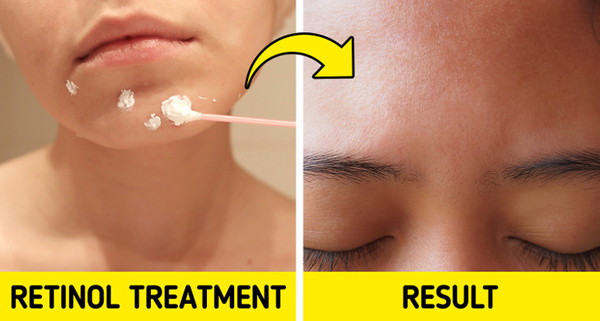 Thử các sản phẩm có retinol. Chuyên gia chăm sóc da tin rằng retinol là thành phần có thể giảm mụn thịt hiệu quả. Nguyên nhân bởi các loại kem retinol có khả năng giúp da trở nên mịn màng, ngăn ngừa sự tích tụ gây bít tắc lỗ chân lông.