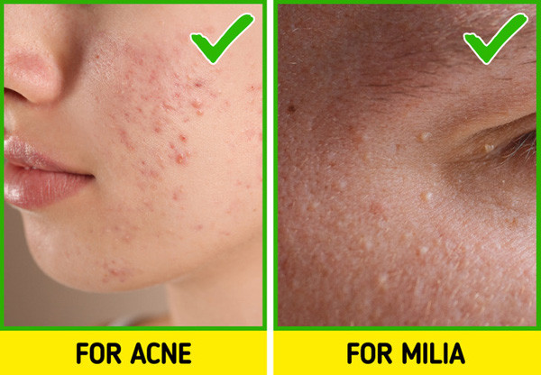 Sử dụng axit salicylic. Axit salicylic được khuyên dùng để chống lại mụn trứng cá, hiệu quả với mụn thịt. Khi bôi lên da, axit salicylic làm mỏng các lớp da, từ đó giải phóng mụn thịt. Thời điểm lý tưởng để bôi axit salicylic là trước khi đi ngủ.