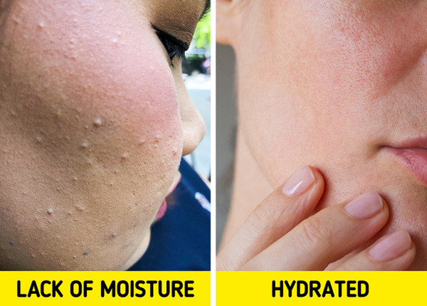 Dưỡng ẩm, chăm sóc da. Dưỡng ẩm, chống nắng là bước chăm sóc da không thể thiếu, giúp giảm tình trạng mụn thịt. Những sản phẩm này giúp bảo vệ da, giữ nước khiến da luôn đàn hồi, mềm mại. Từ đó, tránh được những yếu tố gây hại, lão hóa da. Lưu ý, cần thoa kem chống nắng đầy đủ dù trời râm mát hay ở trong nhà.