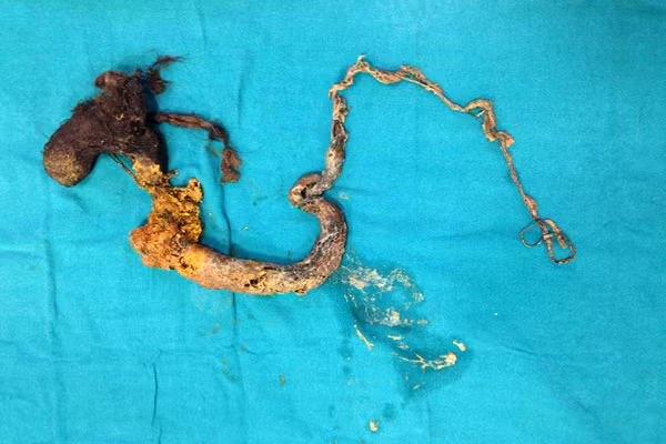 Thật nguy hiểm vì nếu để lâu hơn, búi tóc sẽ chiếm hết không khí trong khoang bụng và nguy cơ cậu bé sẽ không thể sống được. Tóc đã đi từ dạ dày và ruột, khi bác sỹ lấy tóc ra, nó đã cuộn thành hình như một cái dạ dày.