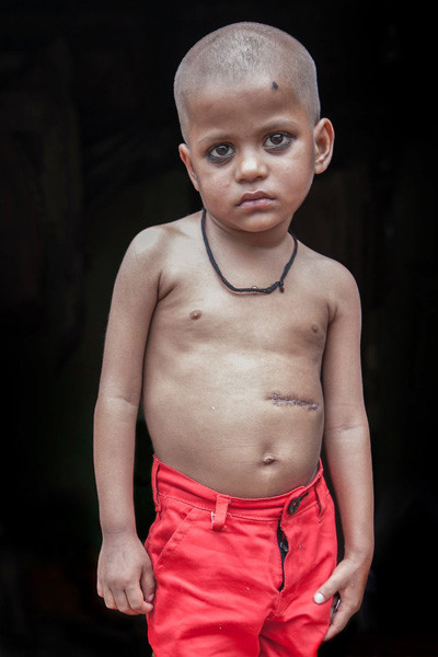 Tiến sỹ Shilpa cho biết, cậu bé Sivam là 1 trong 4 trường hợp trên thế giới bị hội chứng hiếm gặp này và hầu hết thường gặp ở các bé gái tuổi teen. Bác sỹ sẽ phải can thiệp bằng biện pháp tâm lý để làm cho các bé không thèm tóc nữa.