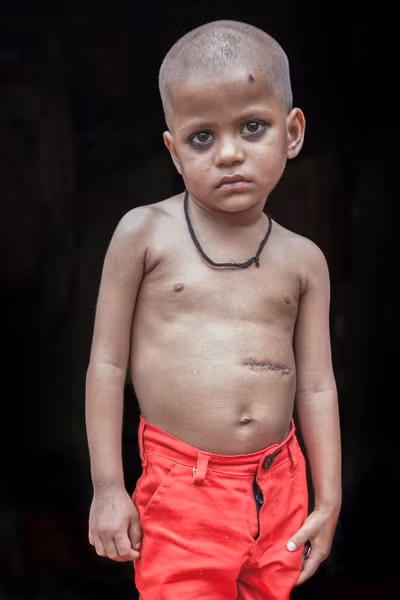 Tiến sỹ Shilpa cho biết, cậu bé Sivam là 1 trong 4 trường hợp trên thế giới bị hội chứng hiếm gặp này và hầu hết thường gặp ở các bé gái tuổi teen. Bác sỹ sẽ phải can thiệp bằng biện pháp tâm lý để làm cho các bé không thèm tóc nữa.