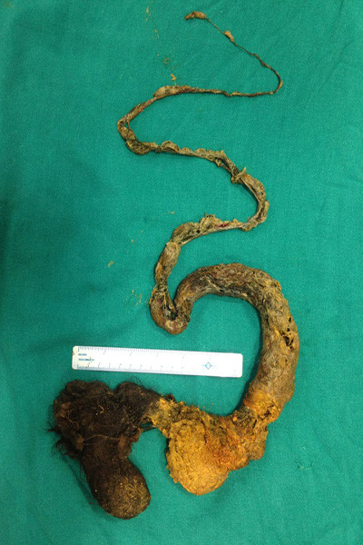 “Tôi đã nhìn thấy Sivam rứt tóc và bỏ vào miệng nhai. Song tôi nghĩ là không vấn đề gì vì nó sẽ đi ra theo đường phân. Không ngờ con lại ăn tóc trong vòng 9 tháng”. Bà mẹ nức nở. “Tạ ơn chúa là con tôi vẫn còn sống được và bây giờ sức khỏe đã tạm ổn”. Họ đã quyết định cạo trọc đầu Sivam để nguy hiểm không xảy ra một lần nữa.