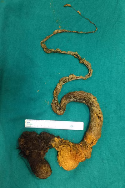 “Tôi đã nhìn thấy Sivam rứt tóc và bỏ vào miệng nhai. Song tôi nghĩ là không vấn đề gì vì nó sẽ đi ra theo đường phân. Không ngờ con lại ăn tóc trong vòng 9 tháng”. Bà mẹ nức nở. “Tạ ơn chúa là con tôi vẫn còn sống được và bây giờ sức khỏe đã tạm ổn”. Họ đã quyết định cạo trọc đầu Sivam để nguy hiểm không xảy ra một lần nữa.