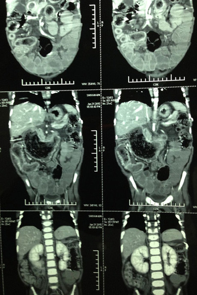 Cha của bé, ông Sunil Kumar, 36 tuổi, nói: "Con tôi khóc cả ngày và làm cách nào bé cũng không ngừng khóc. Chúng tôi đã đưa con đến gặp bác sỹ nhưng họ không thể chẩn đoán ra bệnh”. Thậm chí, một bác sỹ gần nhà đã nói bé bị nhiễm trùng dạ dày và kê đơn uống thuốc. Sau đó, bụng của bé phình ra bất thường. Cuối cùng, tiến sỹ y khoa Shilpa Sharma đã cho chụp CT và phát hiện một búi tóc lớn trong dạ dày bé. Họ đã không thể tin được, búi tóc dài hơn 1,2m.