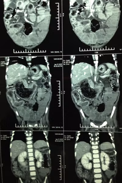 Cha của bé, ông Sunil Kumar, 36 tuổi, nói: "Con tôi khóc cả ngày và làm cách nào bé cũng không ngừng khóc. Chúng tôi đã đưa con đến gặp bác sỹ nhưng họ không thể chẩn đoán ra bệnh”. Thậm chí, một bác sỹ gần nhà đã nói bé bị nhiễm trùng dạ dày và kê đơn uống thuốc. Sau đó, bụng của bé phình ra bất thường. Cuối cùng, tiến sỹ y khoa Shilpa Sharma đã cho chụp CT và phát hiện một búi tóc lớn trong dạ dày bé. Họ đã không thể tin được, búi tóc dài hơn 1,2m.