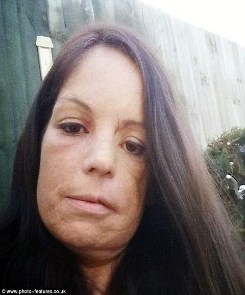 Trước khi phẫu thuật, mặt của Lisa bị biến dạng nặng. Cô luôn bắt gặp những ánh nhìn tò mò và ái ngại của những người xung quanh. Tuy vậy, vì phải nuôi 3 đứa con, cô không có nhiều tiền để đi kiểm tra y tế cẩn thận. Bác sỹ chụp CT và cộng hưởng từ đã cho cô thấy hình ảnh khối u ung thư đã to bằng một quả bóng golf lan dưỡi mũi và má.