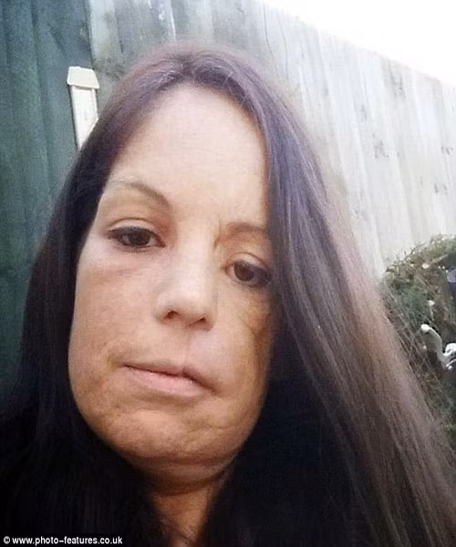 Trước khi phẫu thuật, mặt của Lisa bị biến dạng nặng. Cô luôn bắt gặp những ánh nhìn tò mò và ái ngại của những người xung quanh. Tuy vậy, vì phải nuôi 3 đứa con, cô không có nhiều tiền để đi kiểm tra y tế cẩn thận. Bác sỹ chụp CT và cộng hưởng từ đã cho cô thấy hình ảnh khối u ung thư đã to bằng một quả bóng golf lan dưỡi mũi và má.