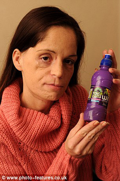 Cô Lisa Epsom dùng răng mở nắp chai nước trái cây cho con, không may răng bị vỡ và cô phải đến nha sỹ kiểm tra. Ở bệnh biện, bác sỹ kiểm tra nướu mới phát hiện ra rằng, cô có một khối u to đang phát triển thành ung thư miệng và nếu để khoảng vài tuần nữa thì sẽ không thể cứu nổi. Cô Lisa cần phải phẫu thuật để loại bỏ khối u ngay lập tức.