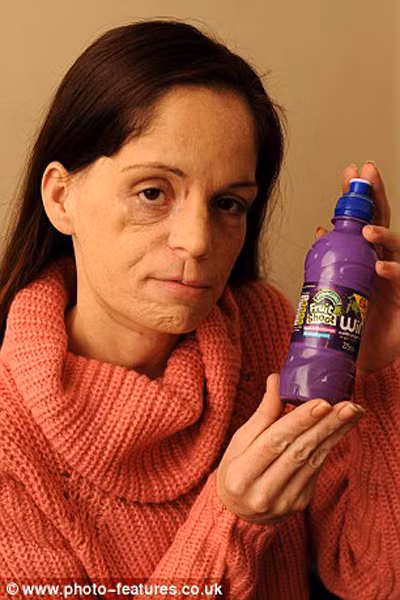 Cô Lisa Epsom dùng răng mở nắp chai nước trái cây cho con, không may răng bị vỡ và cô phải đến nha sỹ kiểm tra. Ở bệnh biện, bác sỹ kiểm tra nướu mới phát hiện ra rằng, cô có một khối u to đang phát triển thành ung thư miệng và nếu để khoảng vài tuần nữa thì sẽ không thể cứu nổi. Cô Lisa cần phải phẫu thuật để loại bỏ khối u ngay lập tức.