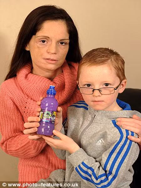 Bác sĩ đã kiểm tra răng và phát hiện một mảng màu đỏ trong vòm miệng. Cô Lisa cho biết, cô đã phát hiện vết lạ này 1 năm về trước nhưng bác sỹ gia đình nói rằng, không có vấn đề gì và cô cũng lãng quên nó đi. Bây giờ, kích thước của vệt lạ này đã to hơn đồng xu. Nghĩa là, khối u ung thư đã đến giai đoạn cuối, cô có thể chết sau vài tuần nữa nếu không được phẫu thuật. Cô Lisa nghĩ đến 3 đứa con và đồng ý.