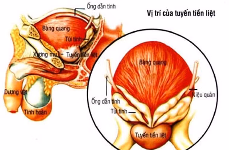 Ung thư tuyến tiền liệt. Bằng cách chú ý những dấu hiệu nhỏ tưởng chừng không liên quan, nam giới vẫn có thể phát hiện kịp thời và chẩn đoán bệnh ung thư tiền liệt tuyến một cách sớm nhất. Những dấu hiệu sớm được phát hiện như, khó khăn tiểu tiện, giảm lực trong dòng nước tiểu, có máu trong nước tiểu hay trong tinh dịch, sưng ở chân và khó chịu ở vùng xương chậu.