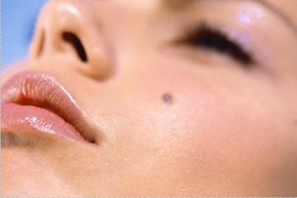 Ung thư da. Khi các loại mụn cóc, nốt ruồi, tàn nhang có thay đổi về màu sắc, kích cỡ, hình dạng hoặc mờ nhạt đường viền, bạn nên đi kiểm tra ung thư da hoặc những loại ung thư khác trên da. Bởi những thay đổi về da có thể là dấu hiệu của ung thư, chẳng hạn da nhìn tối hơn, vàng da, vàng mắt, da mẩn đỏ, ngứa hoặc tóc mọc dài nhanh khác thường cũng là dấu hiệu sớm của bệnh.