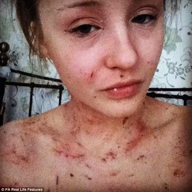 Amy đã bị bệnh chàm nặng đã rất lâu. Bệnh nặng đễn nỗi cô liên tục ngứa và cào cấu da mình khiến toàn thân luôn có đầy vết xước và ửng đỏ. Thậm chí, ngày nào Amy cũng phải đổi ga trải giường vì vết thương rỉ ra và chảy máu.