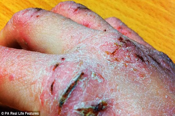 “Có thể mọi người không biết đến sự khó khăn và phiền phức do những vết chàm này gây ra. Họ chỉ thấy rằng đó là những vết đỏ nhưng với tôi thì thật khổ sở. Tôi liên tục phải xin lỗi những người mới lần đầu gặp mặt vì trông tôi thật “ghớm ghiếc” và rất mặc cảm khi đi ra ngoài”, Amy cho biết.