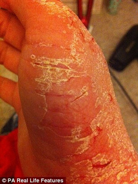 Nhưng giờ đây, cô đã tìm ra một liệu pháp hiệu quả để cải thiện căn bệnh của mình là cháo yến mạch. Những biểu hiện của bệnh giảm đáng kể và cô có thể tự tin ra ngoài mà không còn phải bận tâm với bệnh chàm nữa.