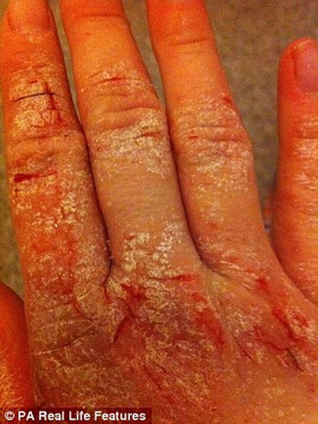 Amy luôn ao ước mình sẽ được mặc những bộ váy hở cổ quyến rũ và đi ra ngoài chơi vào ban đêm như những cô gái khác. Cô luôn phải quấn khăn và mặc quần áo kín để che dấu đi những vết chàm xấu xí.