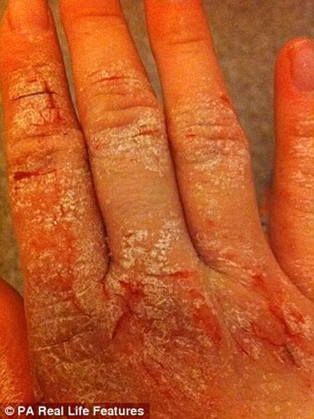 Amy luôn ao ước mình sẽ được mặc những bộ váy hở cổ quyến rũ và đi ra ngoài chơi vào ban đêm như những cô gái khác. Cô luôn phải quấn khăn và mặc quần áo kín để che dấu đi những vết chàm xấu xí.