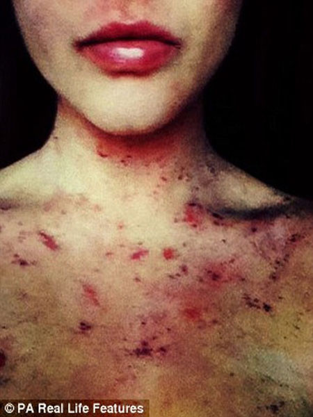 Amy Louise James nói: "Tôi không thể nhớ mình mắc bệnh chàm khi nào. Nó bắt đầu trong các nếp gấp của cánh tay khi tôi còn nhỏ. Rồi dần dần lan rộng trên cánh tay, trên mặt và đầu gối. Tiếp theo đến bụng và trên chân của mình".