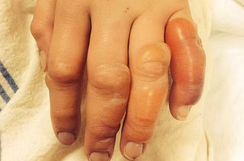 Bác sĩ Randall Friesen cho biết: “ Vết đau và áp lực do bị phồng rộp gây ra cảm giác rất khó chịu. Tuy nhiên, thật may mắn Emma không phải phẫu thuật cắt bỏ những ngón tay bị bỏng”.