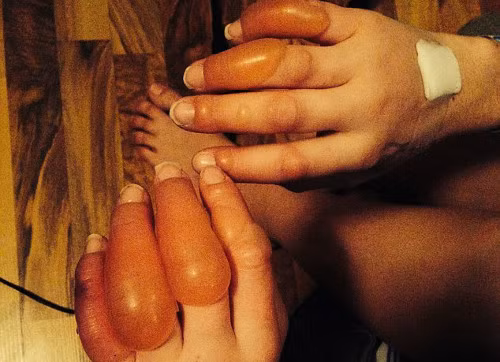 Khi quá say, Emma ngủ thiếp ở bên ngoài quán bar. Khoảng 5h45’ sáng (giờ địa phương), các bạn cô tìm thấy Emma trong tình trạng các ngón tay phồng rộp, sưng vù như nải chuối.