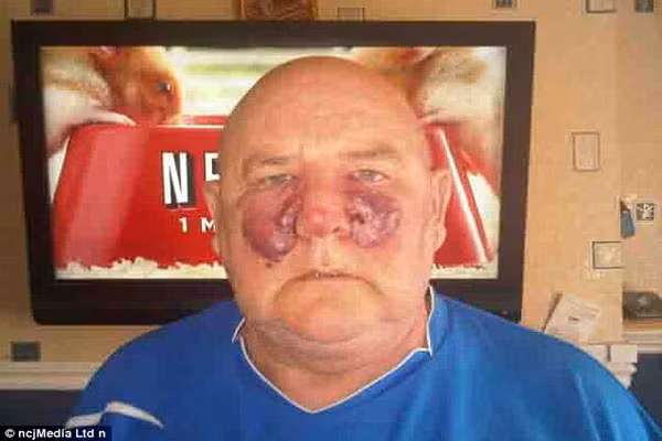 Bác sỹ tại bệnh viện đã chẩn đoán Raymond bị ung thư niêm mạc hiếm gặp và ông đã phải trải qua 12 giờ phẫu thuật để loại bỏ khối u trên mặt. Các bác sỹ đã lấy da từ đùi của ông để sửa lại mặt mũi. Song, những tháng gần đây, một khối u đã phát triển dưới mắt của ông và bệnh ung thư quay trở lại.