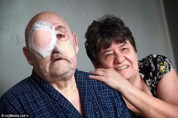 Gần đây, mắt của ông Martin chảy máu liên tục và ông thường xuyên phải thay gạc thấm mủ và máu.