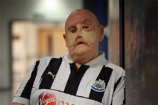 Ban đầu khối u chỉ xuất hiện một chấm nhỏ, sau đó lây lan khắp hai bên má làm biến dạng khuôn mặt. Bác sĩ gia đình chẩn đoán ông bị nhiễm trùng và cho uống kháng sinh. Tuy nhiên, thuốc kháng sinh không có tác dụng nên ông đã được đưa đến bệnh viện để kiểm tra.