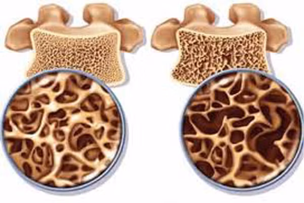 Nếu khối u nằm ở các khớp thì bạn sẽ khó cử động, điều này gây khó khăn cho sự di chuyển như, khối u nằm ở chân thì khó đi lại, u nằm ở tay khiến bạn khó cầm nắm và cảm thấy đau nhoi nhói như có vật gì nằm dưới da vậy.