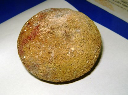 Phẫu thuật sỏi thận khủng trong cơ thể bệnh nhân - Hình 2 Phau thuat soi than khung trong co the benh nhan-Hinh-2