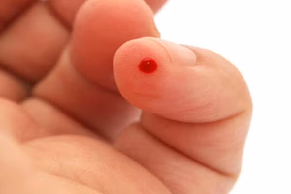 6. Thường xuyên bị nhiễm trùng. Bệnh bạch cầu cấp hoặc mãn tính đều làm giảm sức đề kháng của cơ thể gây nên tình trạng sốt kéo dài. Ngoài ra, bạn có thể hay bị nhiễm trùng hơn thông thường như nhiễm trùng họng, nhiễm trùng tai, nhiễm trùng da.