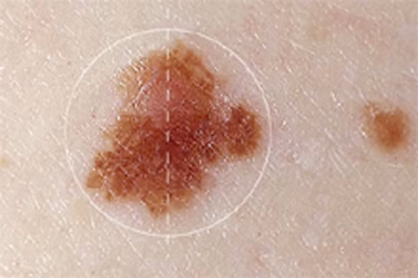 3. Màu sắc. Một nốt ruồi bất bình thường có màu sắc sẽ đồng nhất trên toàn bề mặt. Mặt khác, nếu nó có màu sắc khác nhau từ vùng này sang vùng khác, chẳng hạn như xanh, đỏ, trắng, hay đen. Đây cũng là một lý do bạn nên quan tâm và đến gặp bác sỹ để kiểm tra.