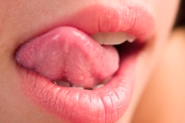  Cục u trên lưỡi. Phía cạnh lưỡi tiếp xúc với răng có thể phát triển các khối u. Nếu các khối u này không được điều trị sẽ lớn dần và loét ra. Cục u có thể màu đỏ hoặc trắng, gây khó khăn khi ăn, nhai thậm chí là uống nước.