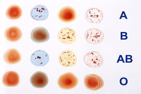 5. Nhóm máu ảnh hưởng tới trí não và bộ nhớ. Chất lỏng duy trì sự sống này có nhiều quyền lực hơn chức năng não. Một nghiên cứu được công bố trên tạp chí Thần kinh Học cho thấy, những người có nhóm máu AB có nguy cơ gặp vấn đề về trí nhớ hơn là những người thuộc nhóm máu O.