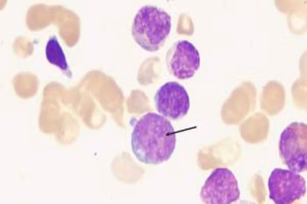 Ngoài ra, những bệnh nhân viêm khớp dạng thấp cũng có nguy cơ cao mắc các loại ung thư da khác có thể chữa trị được. Theo số liệu phân tích năm 2011, những người sử dụng chất ức chế TNF sẽ tăng 45% nguy cơ mắc ung thư da không hắc tố.