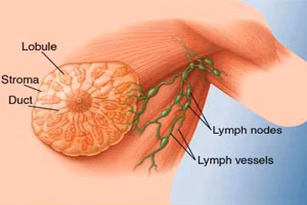 Khi sờ nắn theo đường vòng xung quanh vú thì bạn sẽ thấy có u cục nổi ở trong vú giống như là những viên sỏi nhỏ. Những u cục này có thể là u lành tính hoặc u ác tính, nên đi khám xét để có được hướng điều trị tốt nhất và kịp thời.