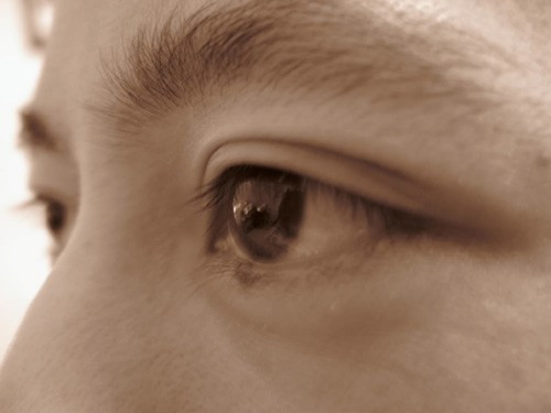 Khác với vết thương ngoài da, máu ở kết mạc khi chảy ra khỏi lòng mạch không tạo dòng hay giỏ rọt ra ngoài không khí. Xuất huyết dưới kết mạc thường là lành tính, tự khỏi mà không cần điều trị gì trừ khi đi kèm với viêm nhiễm hay chấn thương. Bạn nên gặp bác sĩ nội khoa để dừng, giảm liều, hay chuyển đổi nếu đang dùng thuốc chống đông.