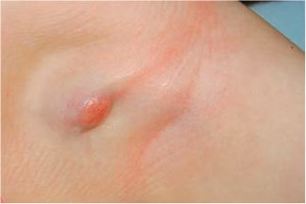 Sưng hạch bạch huyết. Nhiều người sợ hãi và nghi ngờ nó là dấu hiệu ung thư khi hạch trắng nổi các nơi trên cơ thể, hoặc tập trung ở đầu và cổ. Hạch bạch huyết, còn được gọi là các tuyến, đóng vai trò quan trọng trong khả năng của cơ thể chống lại virus, vi khuẩn và các nguyên nhân khác của bệnh tật. Thông thường, các hạch bạch huyết sưng và bị viêm do nhiễm trùng, đặc biệt là nhiễm virus, chẳng hạn như cảm lạnh thông thường.