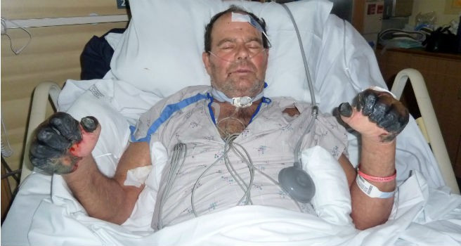  Dịch hạch: Dịch hạch là căn bệnh kinh hoàng với tỷ lệ tử vong cao trong lịch sử nhân loại, có tính truyền nhiễm nguy hiểm do vi khuẩn yersinia pestis gây ra. Bệnh lây truyền chủ yếu từ động vật gặm nhấm sang người qua vật trung gian là bọ chét. Người mắc bệnh có những triệu chứng sốt, đau đầu, mệt mỏi, hoại tử và sưng hạch bạch huyết, đặc biệt ở nách và háng. Được mệnh danh là "Cái chết đen", thời kỳ 1346-1350, dịch hạch lan rộng làm rung chuyển châu Âu, Trung Đông, Nga và phía bắc châu Á. Hai phần ba số người nhiễm bệnh thiệt mạng chỉ trong vòng 4 ngày. Ảnh: Ibtimes