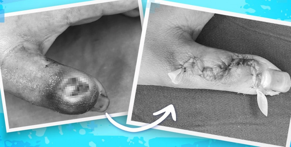 Loat hau qua dang so vi tu dap thuoc la chua nhot