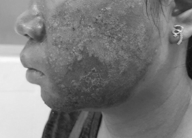 Da mặt nhiễm trùng, mưng mủ sau khi lăn kim tại spa Da mat nhiem trung, mung mu sau khi lan kim tai spa