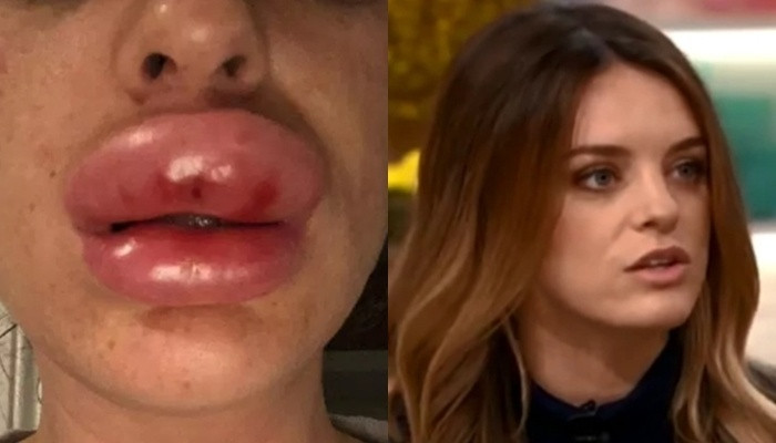 Tiem botox tai nha, gai xinh nhan 