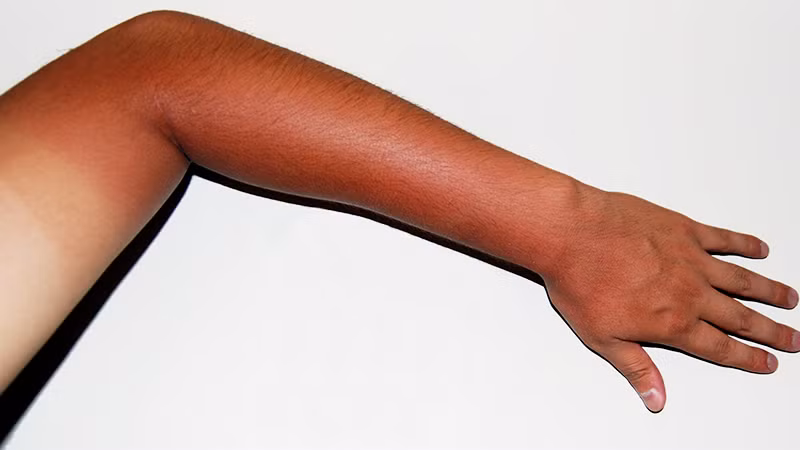 Meo hoi phuc, giam dau rat do bi chay nang ngay he